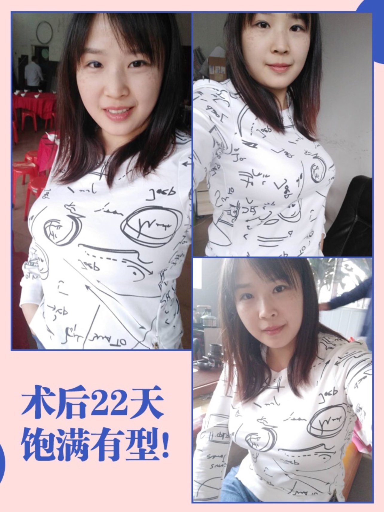 隆胸打针，现代美容新选择-第3张图片