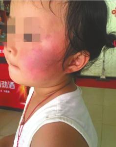 巴掌 红肿 臀瓣疼痛巴掌红肿