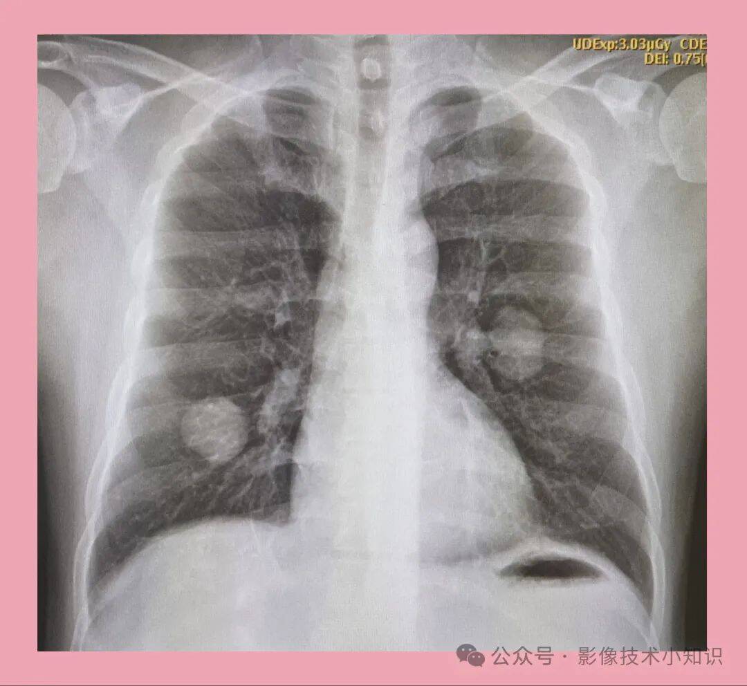 免费的胸片曝光2023更新免费的胸片曝光2023更新